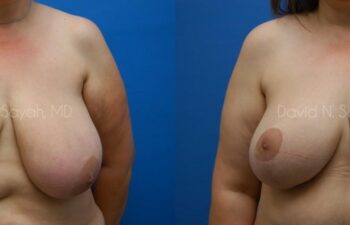 Breast Lift Before and After | Sayah Institute