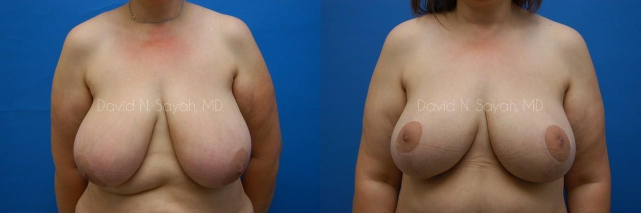 Breast Lift Before and After | Sayah Institute