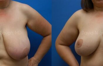 Breast Lift Before and After | Sayah Institute