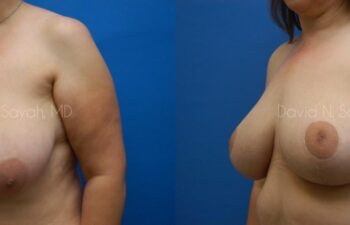 Breast Lift Before and After | Sayah Institute
