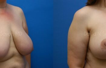 Breast Lift Before and After | Sayah Institute