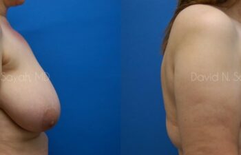 Breast Lift Before and After | Sayah Institute