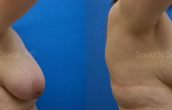 Breast Lift Before and After | Sayah Institute