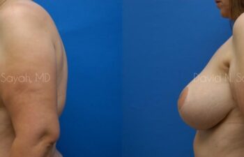 Breast Lift Before and After | Sayah Institute