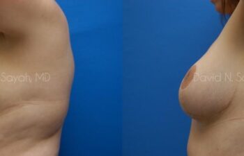 Breast Lift Before and After | Sayah Institute