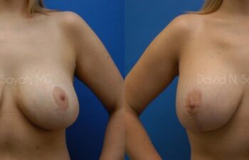 Breast Lift Before and After | Sayah Institute