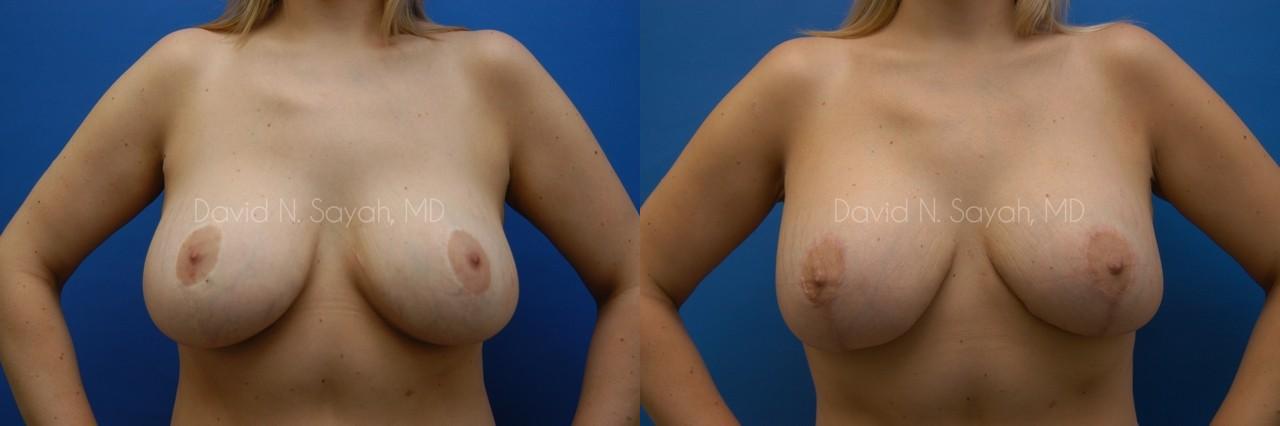 Breast Lift Before and After | Sayah Institute