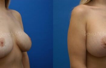 Breast Lift Before and After | Sayah Institute