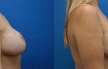 Breast Lift Before and After | Sayah Institute
