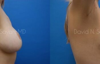 Breast Lift Before and After | Sayah Institute