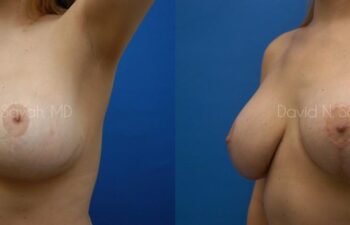 Breast Lift Before and After | Sayah Institute