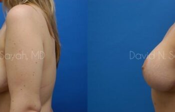 Breast Lift Before and After | Sayah Institute