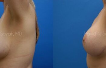 Breast Lift Before and After | Sayah Institute