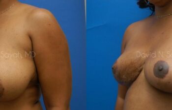 Breast Lift Before and After | Sayah Institute