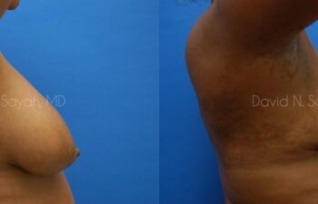 Breast Lift Before and After | Sayah Institute