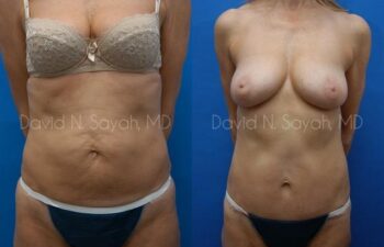 Body Lift Before and After | Sayah Institute