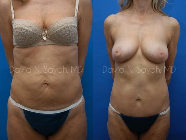 Body Lift Before and After | Sayah Institute