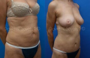 Body Lift Before and After | Sayah Institute