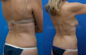 Body Lift Before and After | Sayah Institute