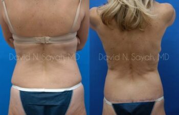 Body Lift Before and After | Sayah Institute