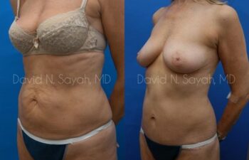Body Lift Before and After | Sayah Institute