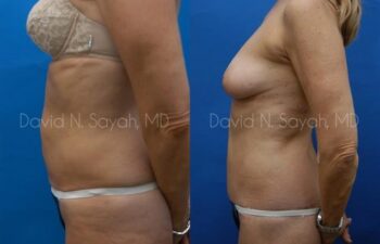 Body Lift Before and After | Sayah Institute