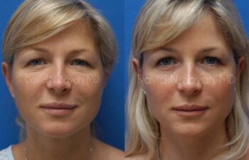 Endoscopic Brow Lift Before and After | Sayah Institute