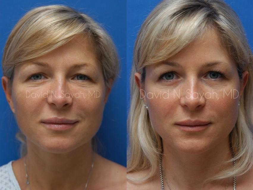 Endoscopic Brow Lift Before and After | Sayah Institute
