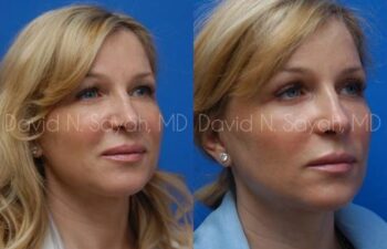 Endoscopic Brow Lift Before and After | Sayah Institute