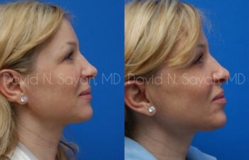 Endoscopic Brow Lift Before and After | Sayah Institute
