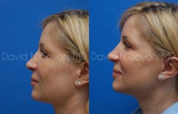 Endoscopic Brow Lift Before and After | Sayah Institute