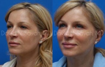 Endoscopic Brow Lift Before and After | Sayah Institute
