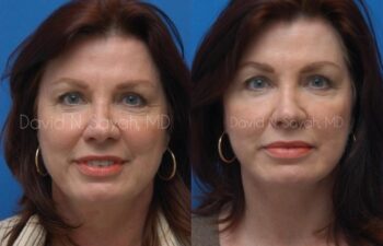 Endoscopic Brow Lift Before and After | Sayah Institute