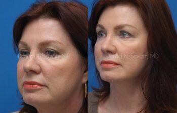 Endoscopic Brow Lift Before and After | Sayah Institute