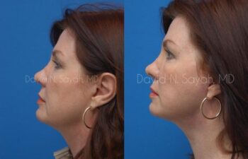 Endoscopic Brow Lift Before and After | Sayah Institute