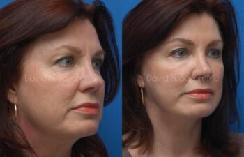 Endoscopic Brow Lift Before and After | Sayah Institute