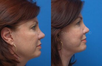 Endoscopic Brow Lift Before and After | Sayah Institute
