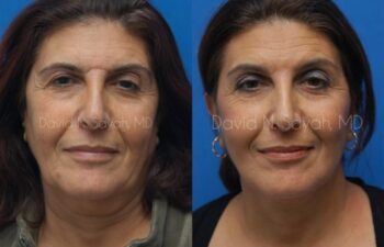 Endoscopic Brow Lift Before and After | Sayah Institute