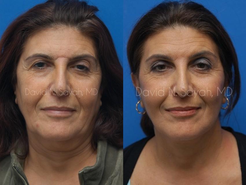 Endoscopic Brow Lift Before and After | Sayah Institute