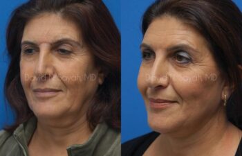 Endoscopic Brow Lift Before and After | Sayah Institute