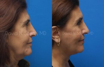 Endoscopic Brow Lift Before and After | Sayah Institute