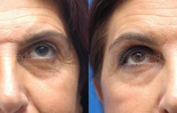Endoscopic Brow Lift Before and After | Sayah Institute