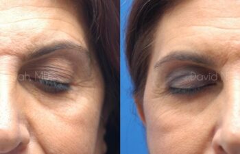Endoscopic Brow Lift Before and After | Sayah Institute