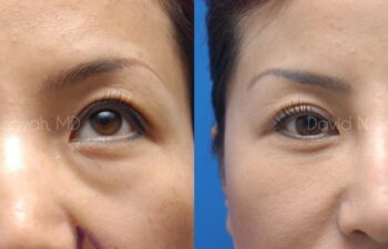 Fat Injection Face Before and After | Sayah Institute