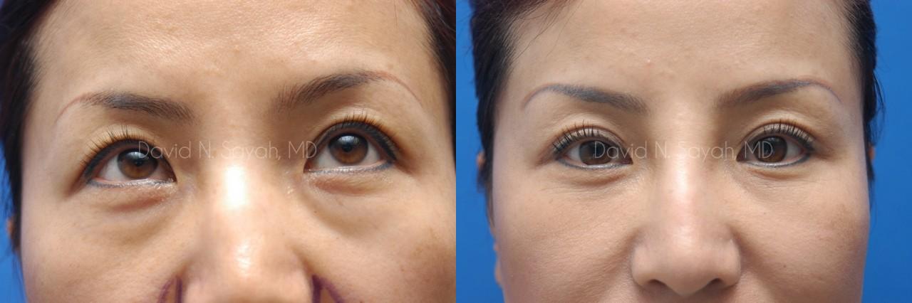 Fat Injection Face Before and After | Sayah Institute
