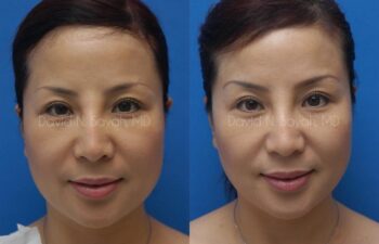 Fat Injection Face Before and After | Sayah Institute