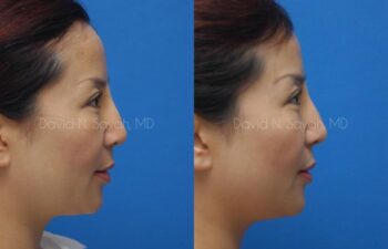 Fat Injection Face Before and After | Sayah Institute