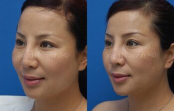Fat Injection Face Before and After | Sayah Institute