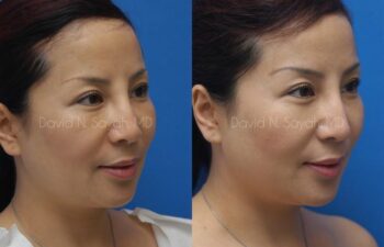 Fat Injection Face Before and After | Sayah Institute