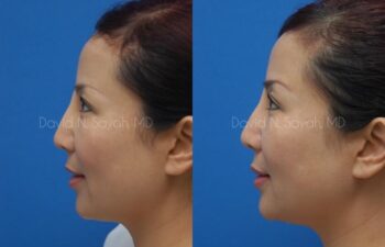 Fat Injection Face Before and After | Sayah Institute